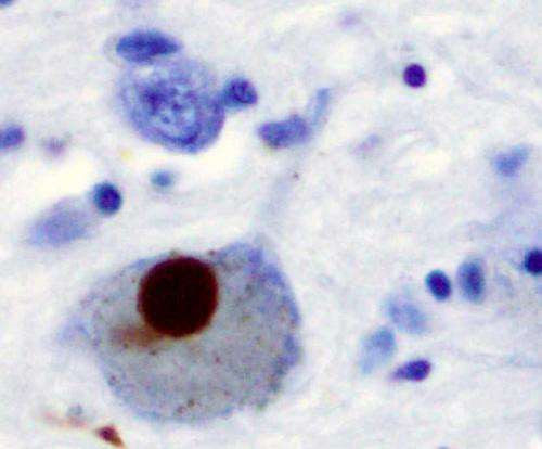 Researchers discover new piece of the puzzle for Parkinson’s disease