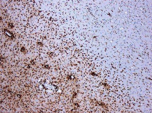 New discovery provides hope for improved multiple sclerosis therapies