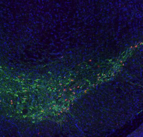 Gene ID’d as potential therapeutic target for dementia in Parkinson’s