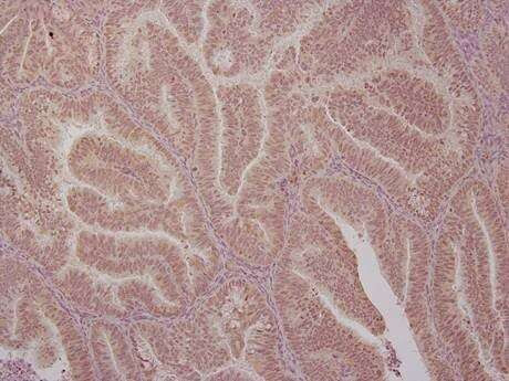 Researchers discover key protein in endometrial cancer growth