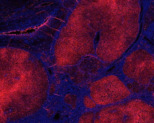 Study: Two Enzymes Control Liver Damage in NASH