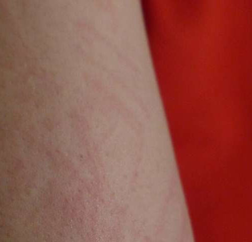 Half of lupus rashes harbor high levels of bacteria responsible for infections