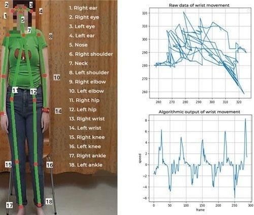 Automatic method to assess severity of myoclonic jerks from video footage