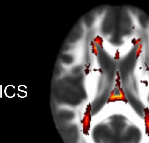 Blood test identifies risk of disease linked to stroke and dementia