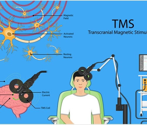 Transcranial Magnetic Stimulation Therapy for Depression