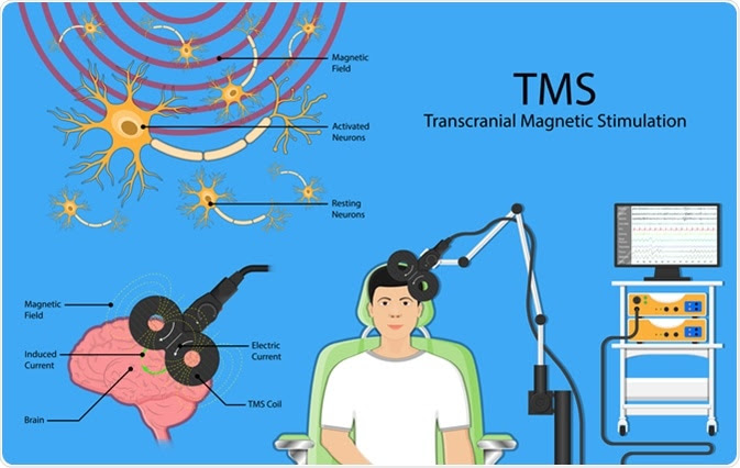 Transcranial Magnetic Stimulation Therapy For Depression Regenerative