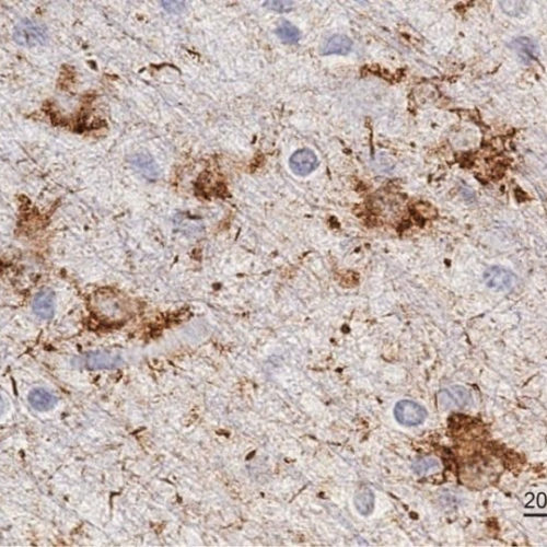 Distinctive Alzheimer’s Symptoms Linked to Damaged Glial Cells