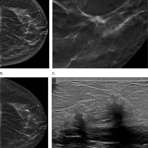 Tomosynthesis outperforms digital mammography in five-year study