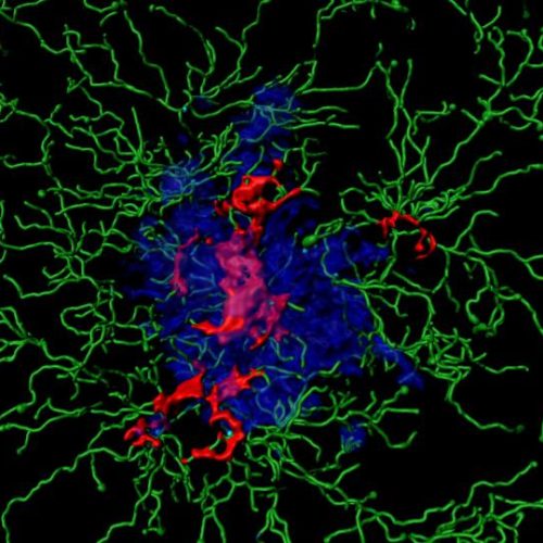 Alzheimer’s disease: Inflammation triggers fatal cycle