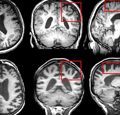 Report: Screen older MS patients for cognitive decline and age-associated neurological conditions