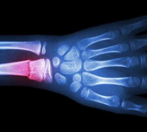 A promising new strategy to help broken bones heal faster