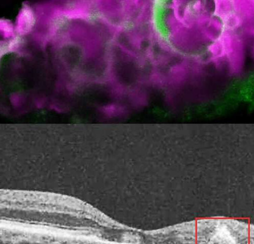 Researchers discover tooth-enamel protein in eyes with dry AMD