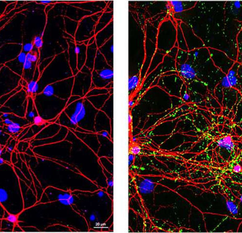 ‘Natural killer’ cells could halt Parkinson’s progression