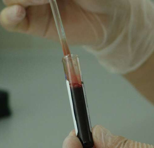 Prostate cancer ‘fingerprint’ detected in blood sample