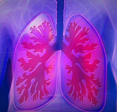 High levels of iron in the lung linked to increased asthma severity