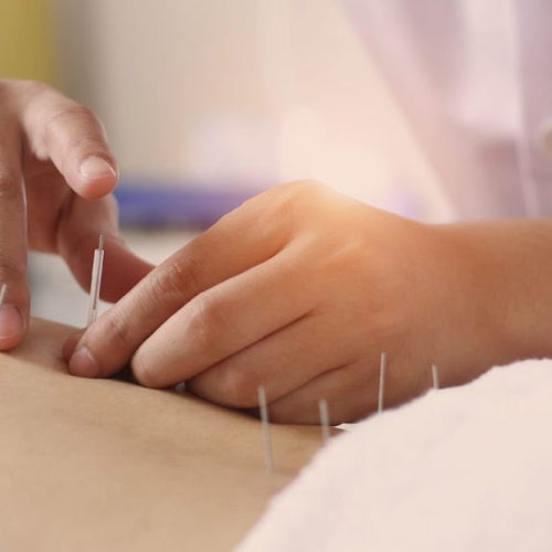 Does Medicare cover acupuncture?