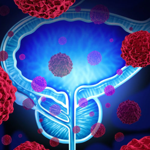 New diagnostic tools aim to catch aggressive prostate cancer early