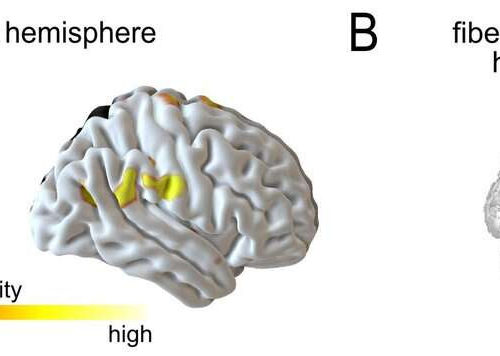 Stroke: When the system fails for the second time