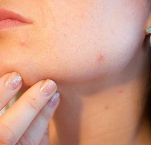 Probiotics may help treat acne