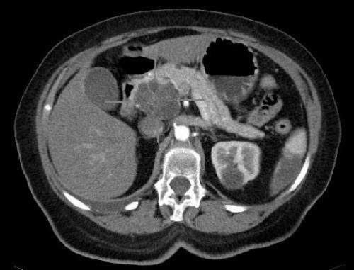 Pancreatic cancer blocked by disrupting cellular pH balance