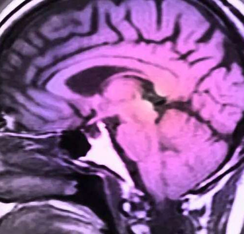 Brain changes from multiple sclerosis may occur in preteens