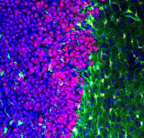 Scientists reveal brain tumors impact normally helpful cells