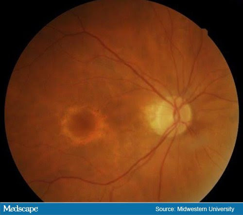 Hydroxychloroquine: Possible COVID Drug Can Be Toxic to Retinas