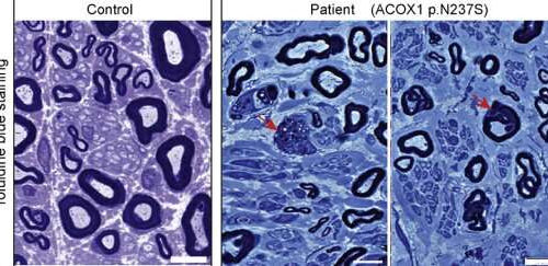 Solving the puzzle of Mitchell disease