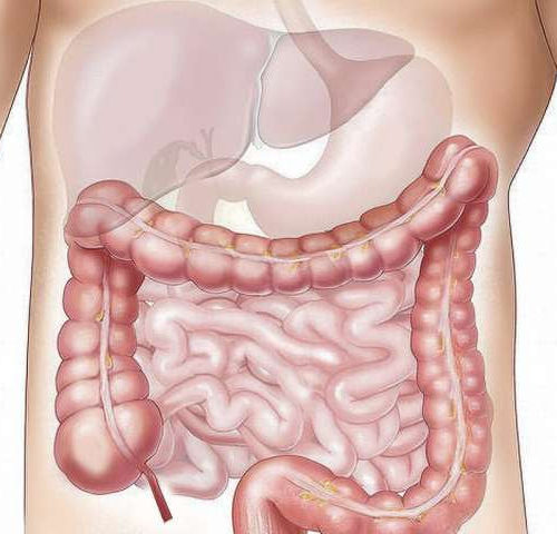 Treatment for diverticulitis: Updated ASCRS guidelines published