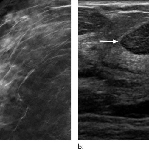 Six-month follow-up appropriate for BI-RADS 3 findings on mammography