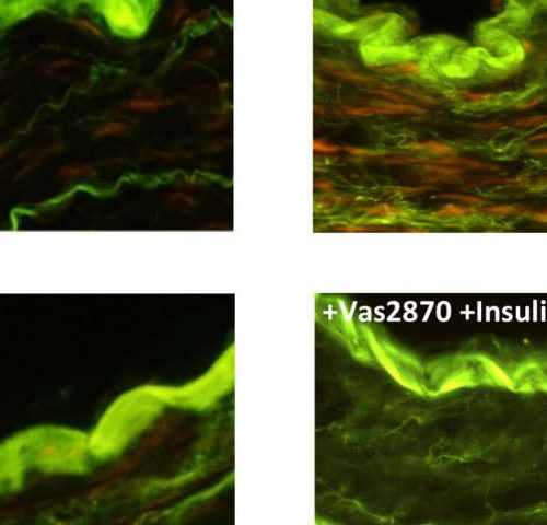 A new approach to treating vascular insulin damage in coronary heart disease