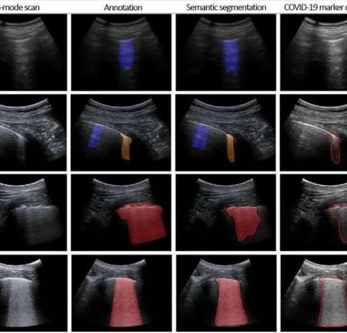 Intelligent lung ultrasound provides crucial support for COVID-19 testing within minutes