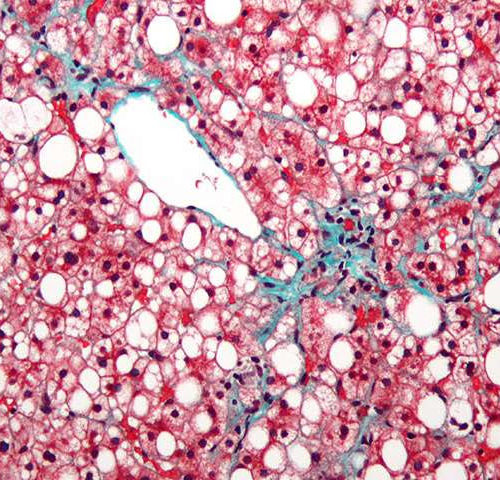 Researchers develop new drugs for treating polycystic hepatorena