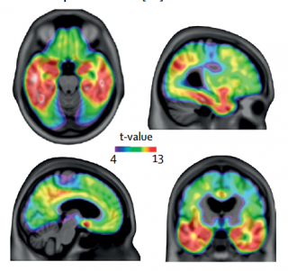 Game-changing blood test accurately detects Alzheimer’s disease