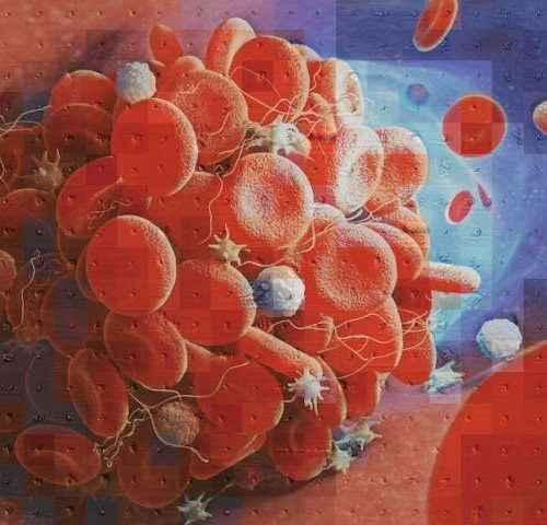 New tool helps distinguish the cause of blood clots