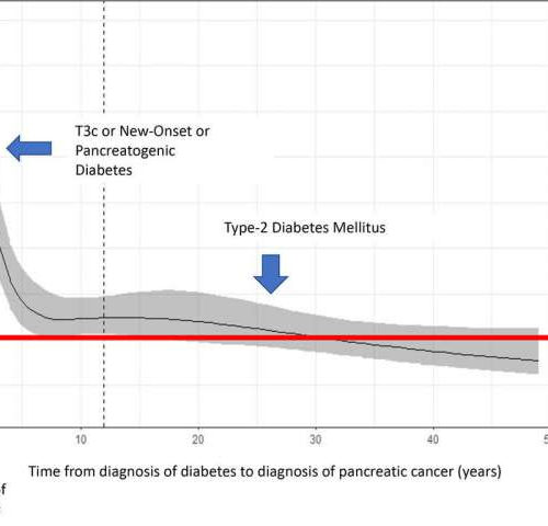 Study confirms diabetes type 3c as early manifestation of pancreatic cancer