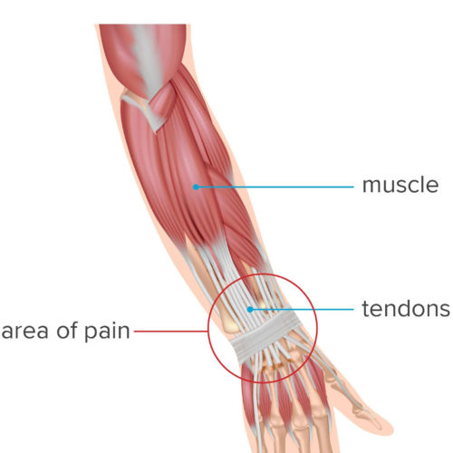 What to know about wrist tendonitis