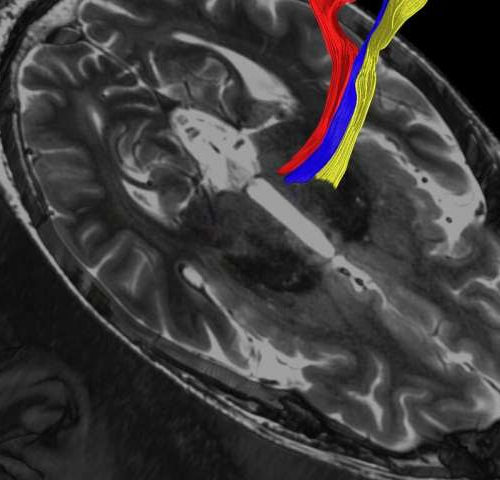 Advanced MRI scans may improve treatment of tremor, Parkinson’s disease