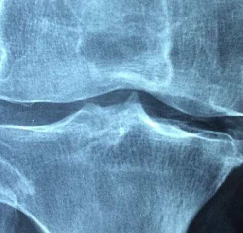Geochemistry test can identify osteoporosis earlier than current ‘gold-standard’ test
