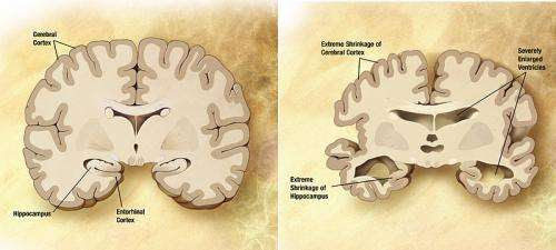 Different ‘subtypes’ of Alzheimer’s may be linked to different modifications of the tau protein