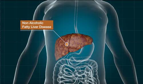 Modified Parkinson’s Drug Shows Potential in Treating Nonalcoholic Fatty Liver Disease