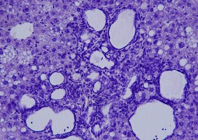 Scientists discover a new mechanism controlling liver cancer development