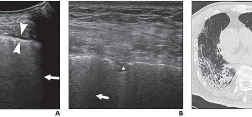 Lung ultrasound shows duration, severity of coronavirus disease (COVID-19)