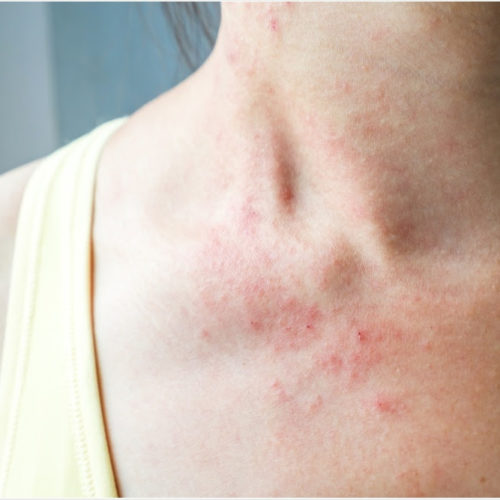 Skin rash may be a symptom of COVID-19