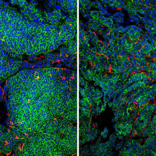 How breast cancer cells sneak past local immune defenses