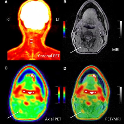 New PET/MRI approach pinpoints chronic pain location, alters management