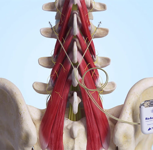 ReActiv8 Neurostimulator Treats Cause of Back Pain, Now FDA Approved