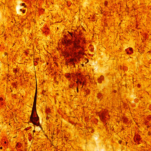 New Clues To ALS And Alzheimer’s From Physics