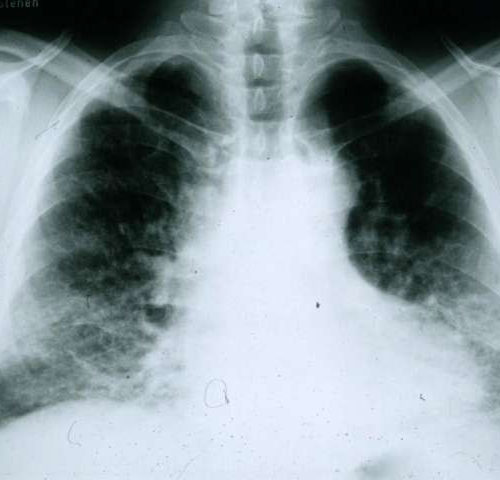 New clues to lung-scarring disease may aid treatment