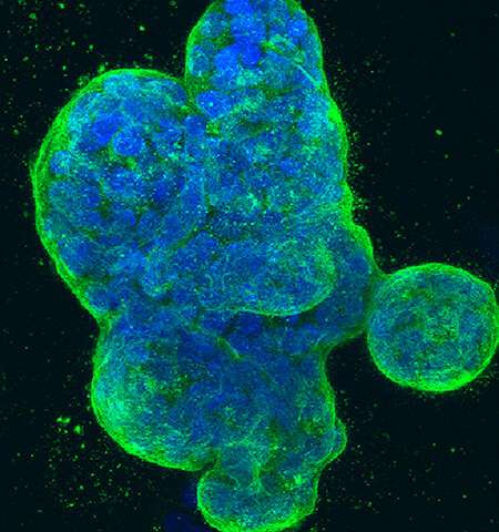 A new way to target cancers using ‘synthetic lethality’